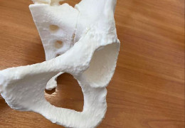 У Чернівецькій області вперше імплантували суглоб, виготовлений на 3D-принтері