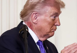 На тілі Трампа знову з’явилися дивні сині плями
